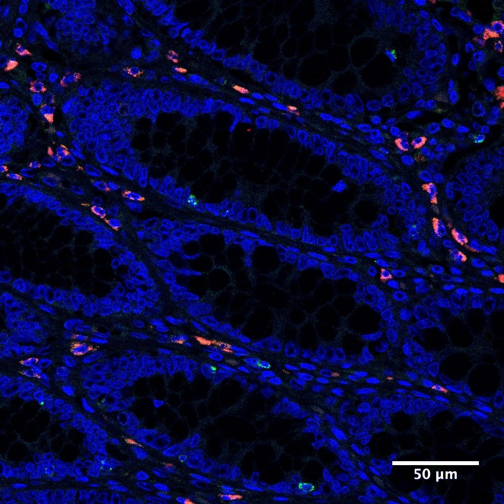 New test could help pinpoint IBD diagnosis, study finds